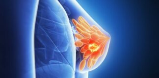 Nanopartículas contra cáncer de mama