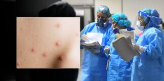 Viruela del mono en Alemania-NDV